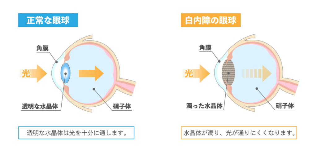 正常な目と白内障の目