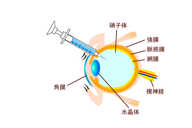 硝子体注射のイメージ