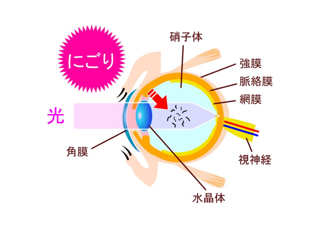 飛蚊症のイメージ