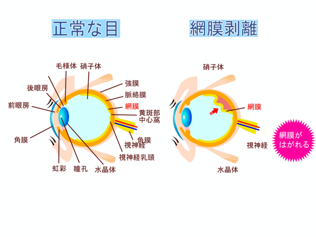 網膜剥離