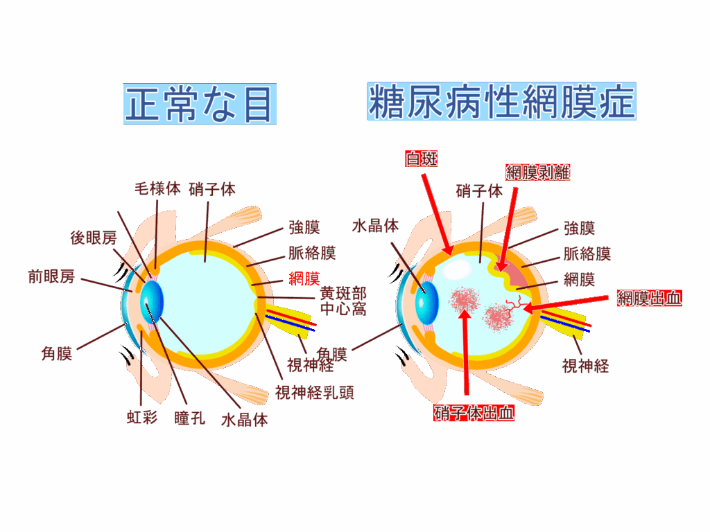 正常な眼内と網膜剥離の眼内