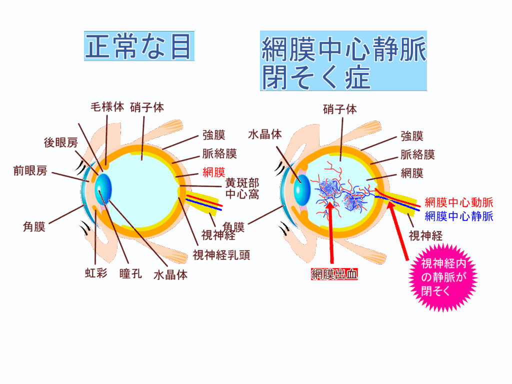網膜静脈閉塞症