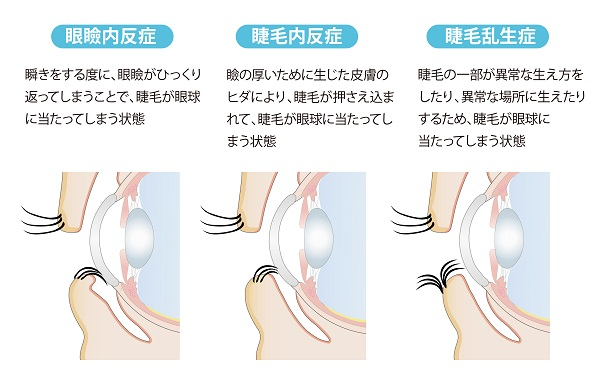 逆まつげの種類
