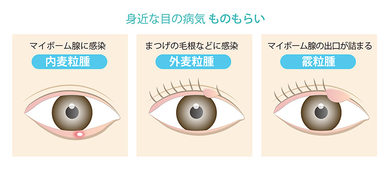ものもらいの種類