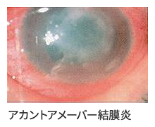 アカウントアメーバー結膜炎