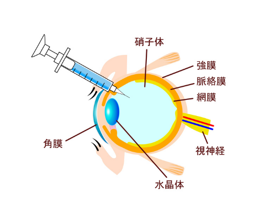 硝子体注射のイメージ